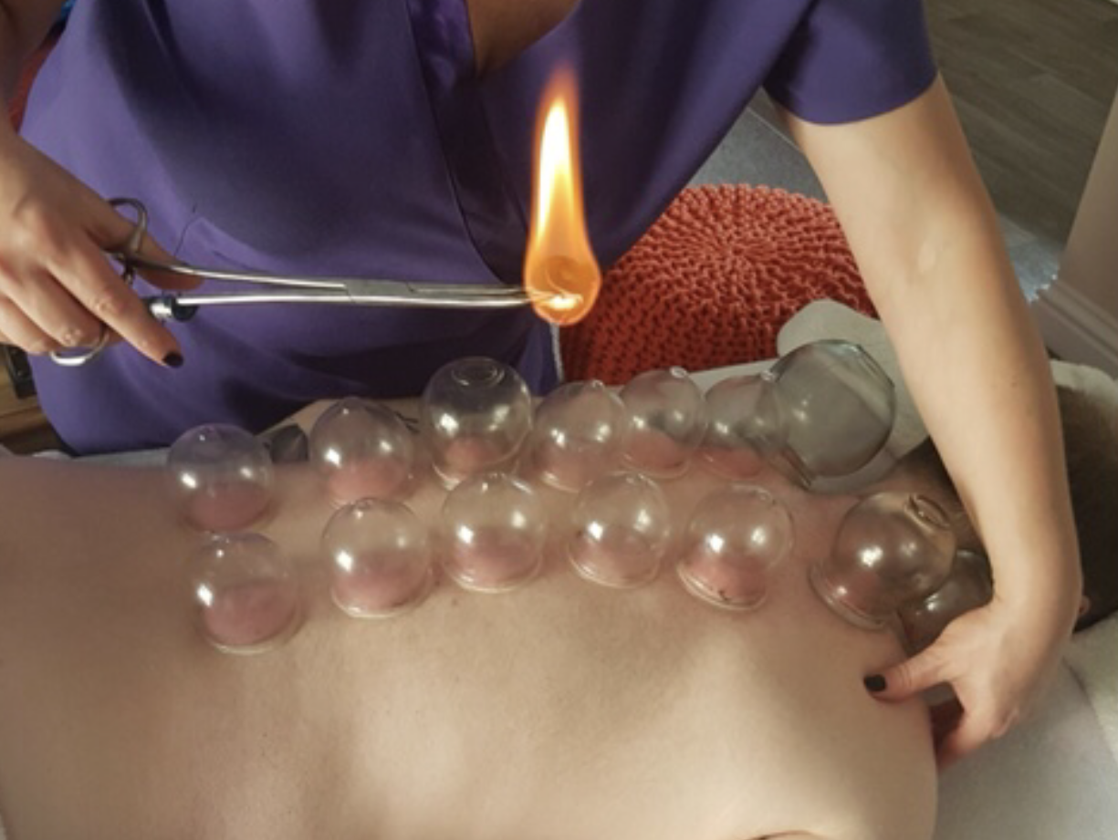 Cupping Therapy
